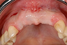 Weiblich, 40 Jahre, Verlust der 4 Oberkieferfrontzähne durch eine Infektion. Therapie: 3 Implantate – Weiß und fest, statt locker und herausnehmbar. 